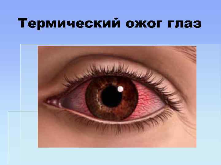 Термический ожог глаз 