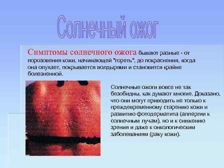Симптомы солнечного ожога бывают разные - от порозовения кожи, начинающей 