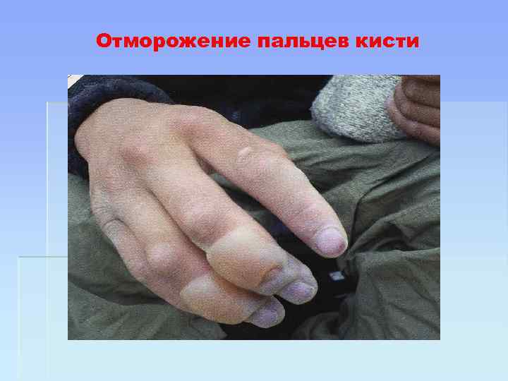 Отморожение пальцев кисти 