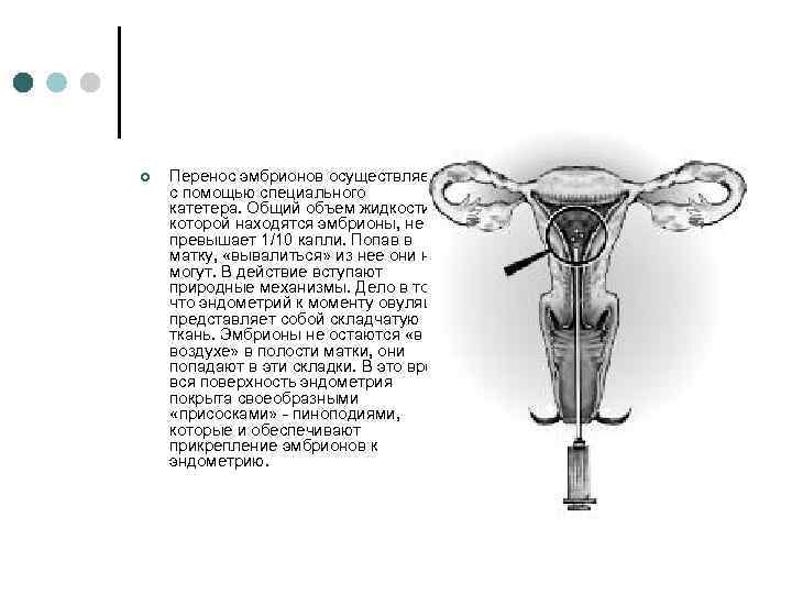 ¢ Перенос эмбрионов осуществляется с помощью специального катетера. Общий объем жидкости, в которой находятся