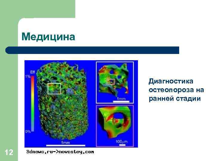 Медицина Диагностика остеопороза на ранней стадии 12 