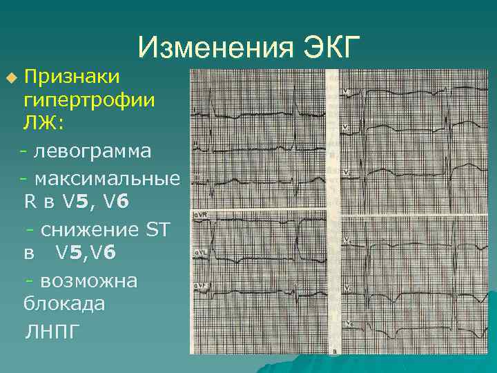 Изменения ЭКГ Признаки гипертрофии ЛЖ: - левограмма - максимальные R в V 5 ,