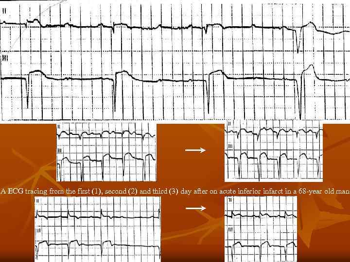 1 2 3 A ECG tracing from the first (1), second (2) and third