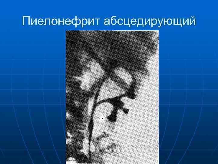 Пиелонефрит абсцедирующий 