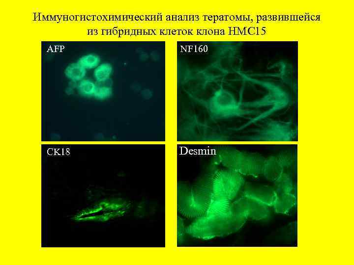 Иммуногистохимический анализ тератомы, развившейся из гибридных клеток клона НМС 15 AFP NF 160 CK