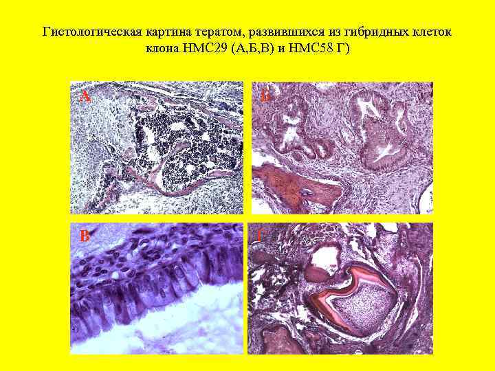 Гистологическая картина тератом, развившихся из гибридных клеток клона НМС 29 (А, Б, В) и
