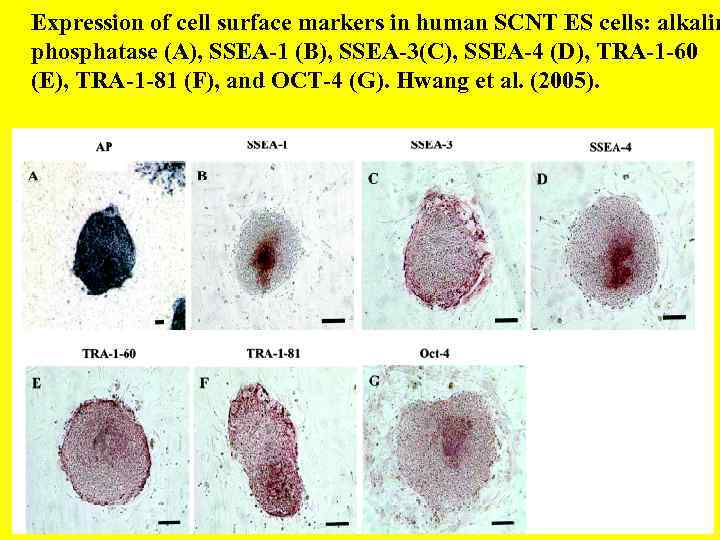 Expression of cell surface markers in human SCNT ES cells: alkalin phosphatase (A), SSEA-1