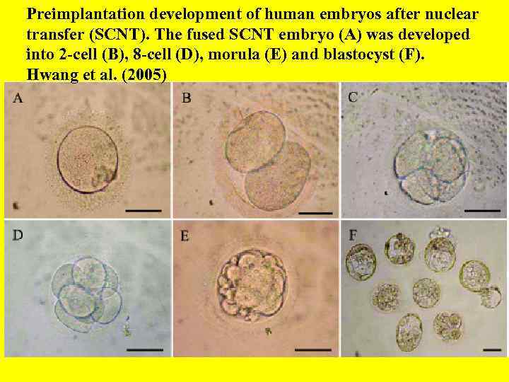 Preimplantation development of human embryos after nuclear transfer (SCNT). The fused SCNT embryo (A)