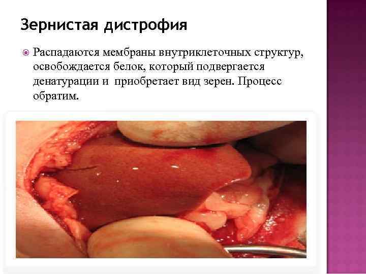 Зернистая дистрофия Распадаются мембраны внутриклеточных структур, освобождается белок, который подвергается денатурации и приобретает вид