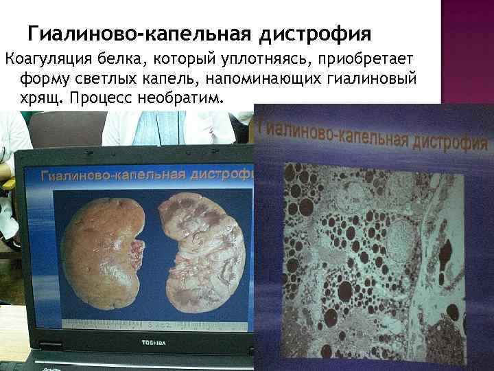 Гиалиново-капельная дистрофия Коагуляция белка, который уплотняясь, приобретает форму светлых капель, напоминающих гиалиновый хрящ. Процесс