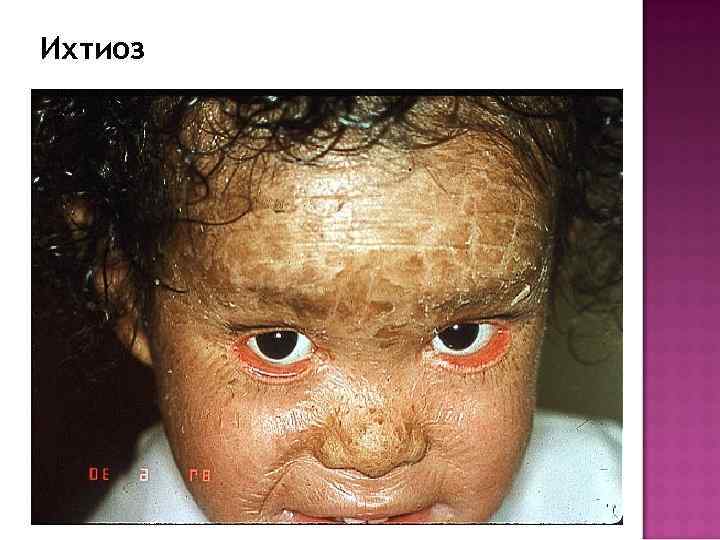 Ихтиоз 