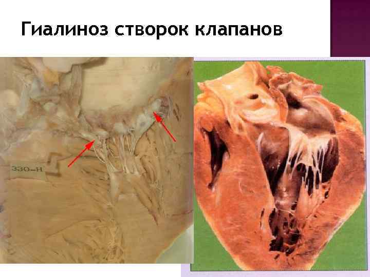 Гиалиноз створок клапанов 