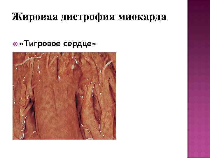 Жировая дистрофия миокарда «Тигровое сердце» 