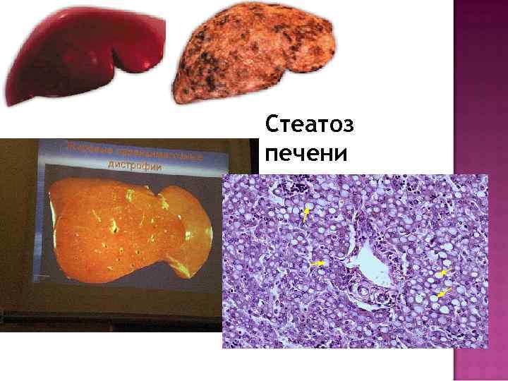Стеатоз печени 