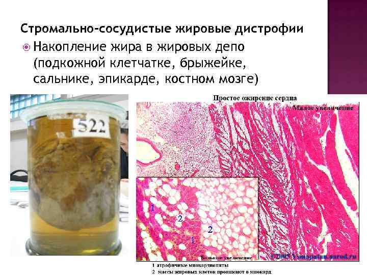 Стромально-сосудистые жировые дистрофии Накопление жира в жировых депо (подкожной клетчатке, брыжейке, сальнике, эпикарде, костном