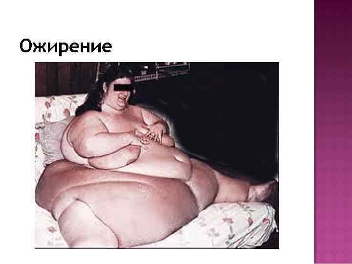 Ожирение 