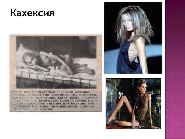 Кахексия 