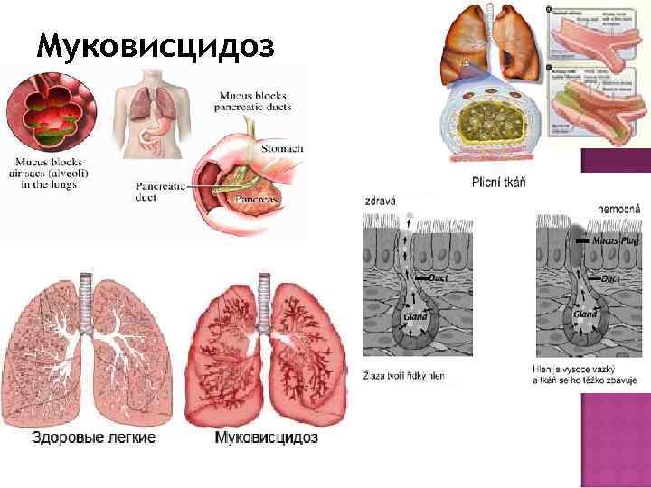 Кистозный фиброз презентация