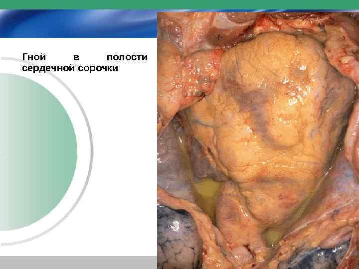 Гной в полости сердечной сорочки 