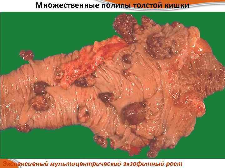 Множественные полипы толстой кишки Экспансивный мультицентрический экзофитный рост 