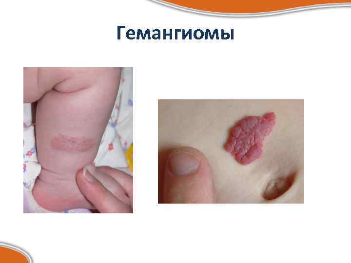 Гемангиомы 