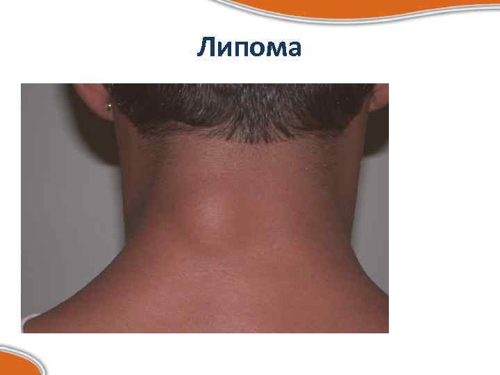 Липома 
