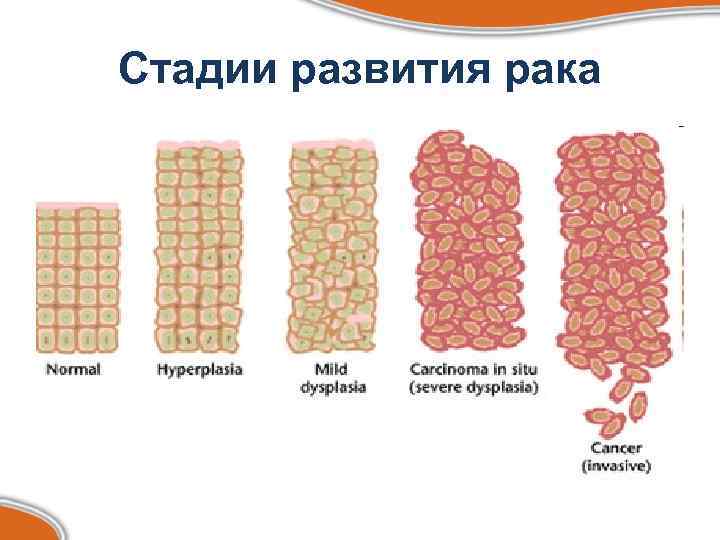 Стадии развития рака 