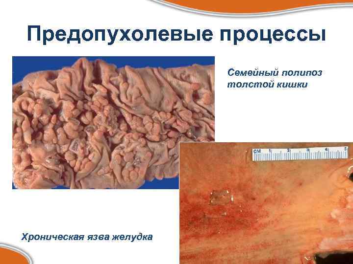 Предопухолевые процессы Семейный полипоз толстой кишки Хроническая язва желудка 