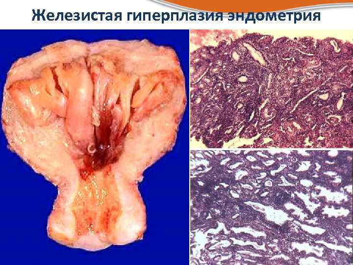 Железистая гиперплазия эндометрия 