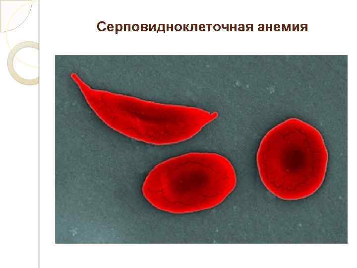 Серповидно клеточная анемия. Сверхдоминирование серповидноклеточная анемия. Серповидноклеточная анемия рецессивный. Серповидная анемия ОАК. Кровь при серповидноклеточной анемии.