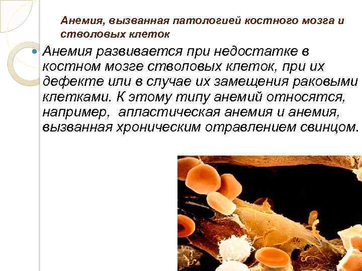 Анемия, вызванная патологией костного мозга и стволовых клеток Анемия развивается при недостатке в костном