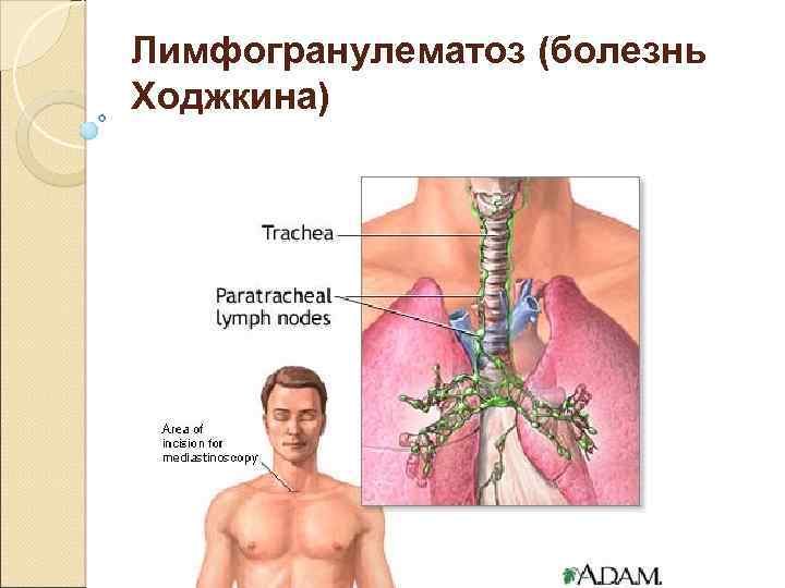 Лимфогранулематоз (болезнь Ходжкина) 