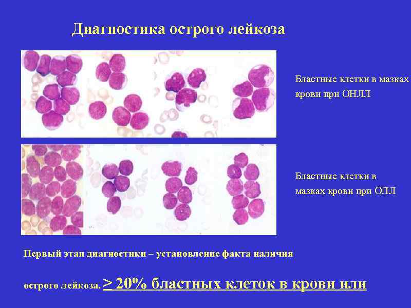 Диагностика острого лейкоза Бластные клетки в мазках крови при ОНЛЛ Бластные клетки в мазках