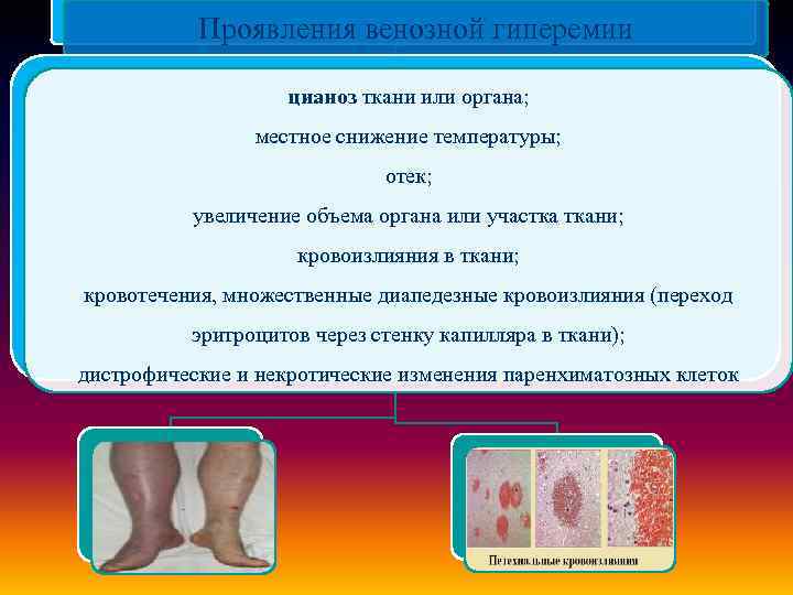 Проявления венозной гиперемии цианоз ткани или органа; местное снижение температуры; отек; увеличение объема органа