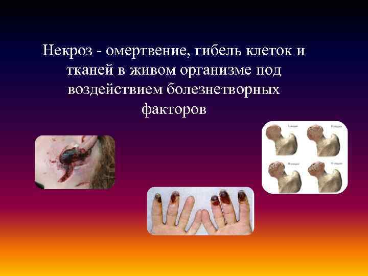 Некроз - омертвение, гибель клеток и тканей в живом организме под воздействием болезнетворных факторов