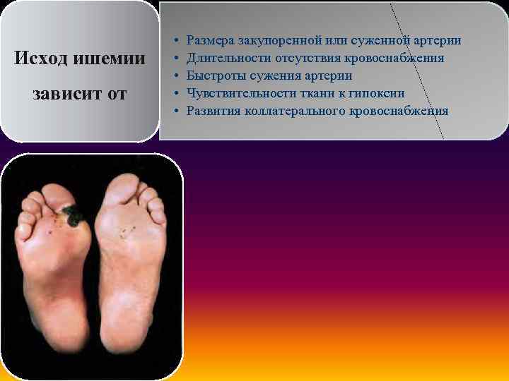Исход ишемии зависит от • • • Размера закупоренной или суженной артерии Длительности отсутствия