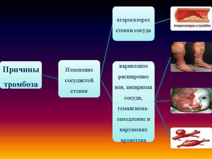 атеросклероз стенки сосуда Причины Изменение тромбоза сосудистой стенки варикозное расширение вен, аневризма сосуда, гемангиомазамедление