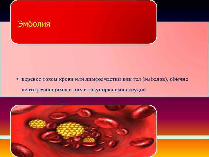 Эмболия • перенос током крови или лимфы частиц или тел (эмболов), обычно не встречающихся