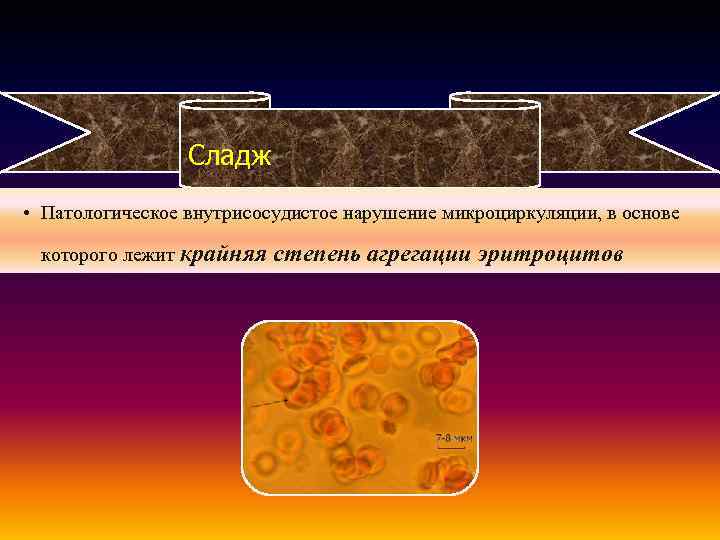 Сладж • Патологическое внутрисосудистое нарушение микроциркуляции, в основе которого лежит крайняя степень агрегации эритроцитов