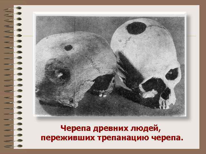Черепа древних людей, переживших трепанацию черепа. 