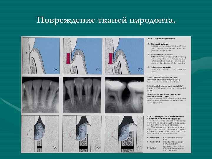 Повреждение тканей пародонта. 