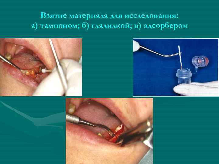 Взятие материала для исследования: а) тампоном; б) гладилкой; в) адсорбером 