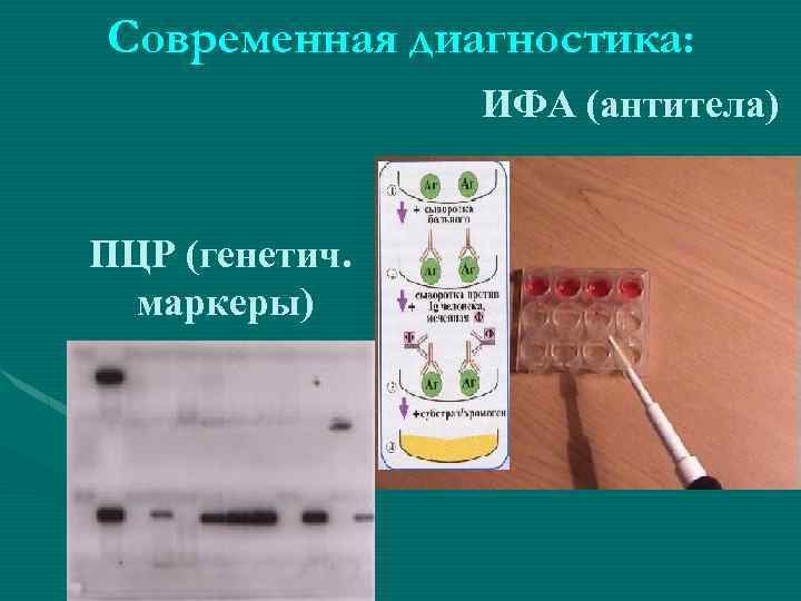 Современная диагностика: ПЦР (генетич. маркеры) ИФА (антитела) 
