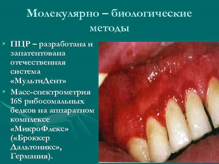 Молекулярно – биологические методы • ПЦР – разработана и запатентована отечественная система «Мульти. Дент»