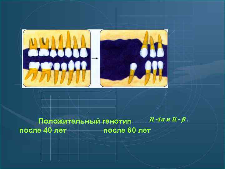 IL-1α и IL- β. Положительный генотип после 40 лет после 60 лет 