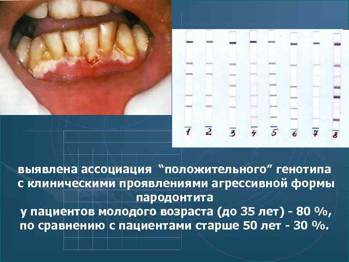 выявлена ассоциация “положительного” генотипа с клиническими проявлениями агрессивной формы пародонтита у пациентов молодого возраста