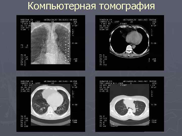 Компьютерная томография 