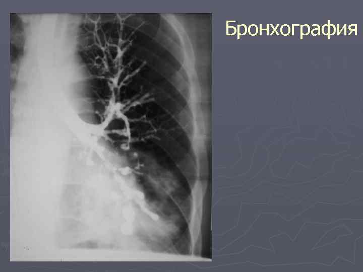 Подготовка легкого