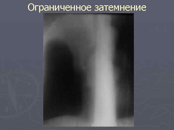 Ограниченное затемнение 