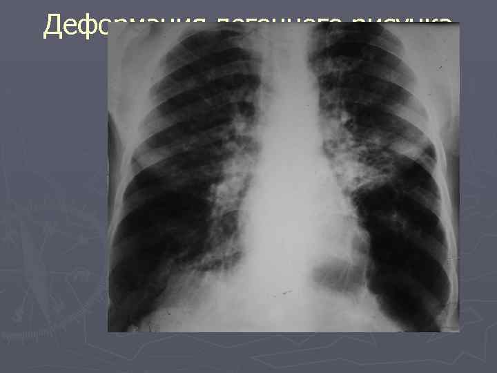 Деформация легочного рисунка 